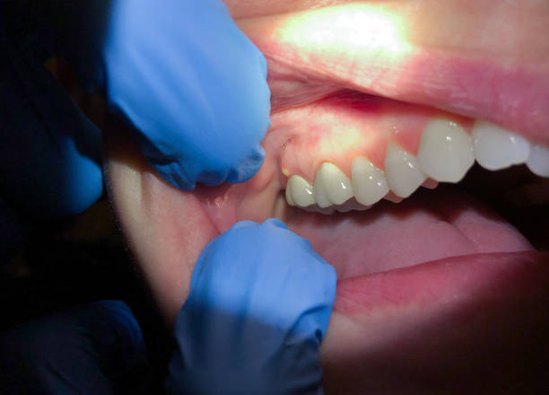 Best Emergency Treatment for Oral Infections in Fall Creek, WI